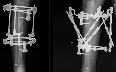 Ekstremitāšu asimetrijas un deformāciju korekcija